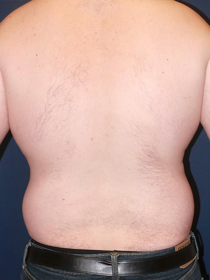 Lipo 360 by Dr. Booth Before & After Gallery - Patient 102012 - Image 7
