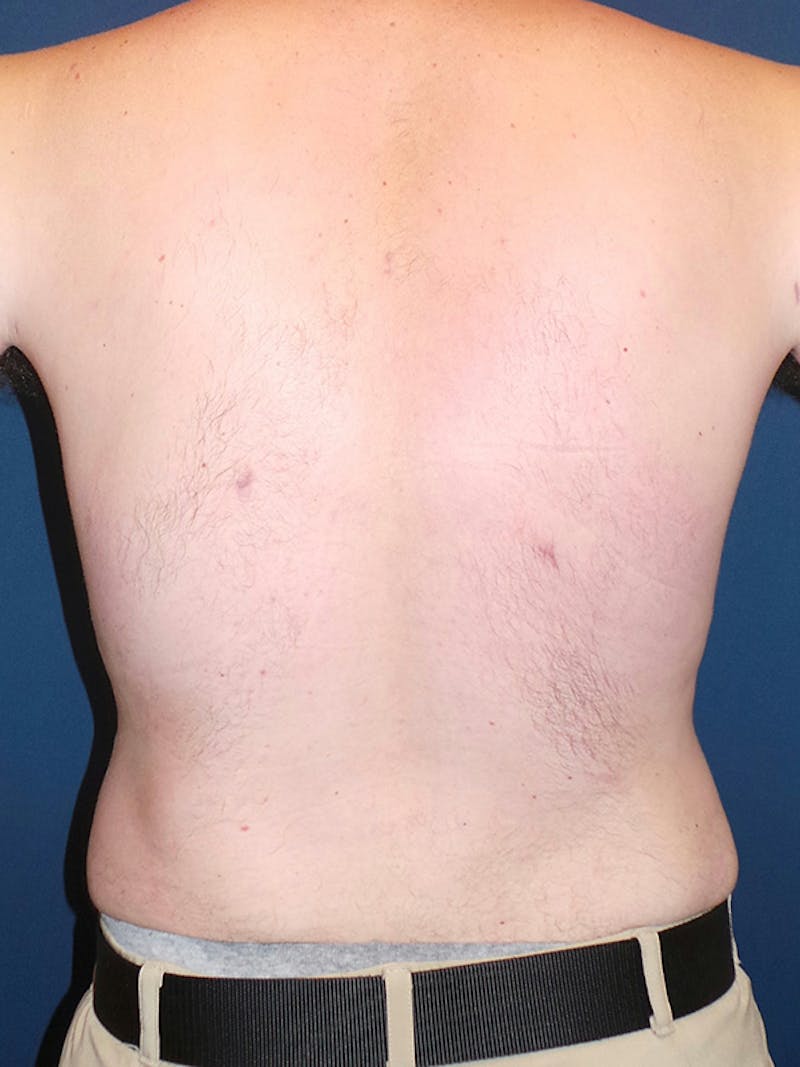 Liposuction by Dr. Booth Before & After Gallery - Patient 748293 - Image 8