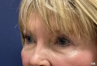 Eyelid Surgery by Dr. Haydon Before & After Gallery - Patient 182293 - Image 6