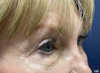 Eyelid Surgery by Dr. Haydon Before & After Gallery - Patient 182293 - Image 4