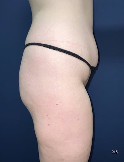Liposuction by Dr. Haydon Before & After Gallery - Patient 130490 - Image 2