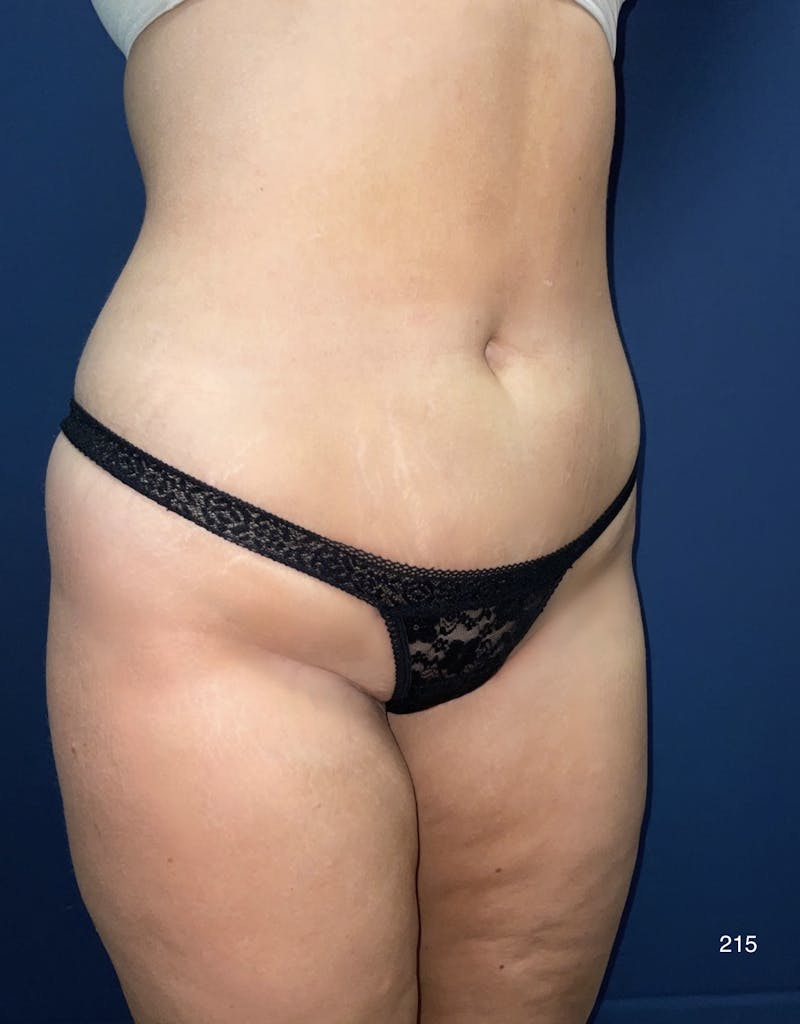 Liposuction by Dr. Haydon Before & After Gallery - Patient 130490 - Image 5