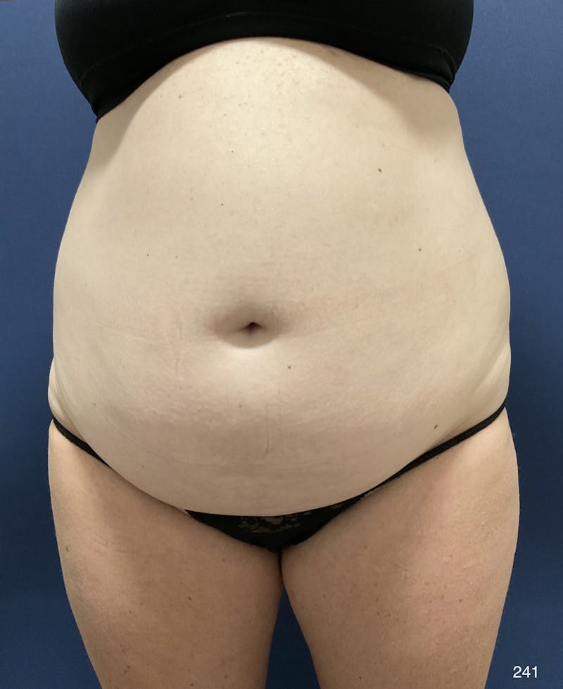 Tummy Tuck by Dr. Haydon Before & After Gallery - Patient 258984 - Image 1