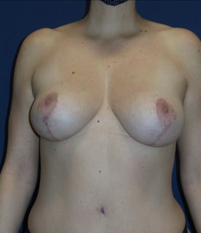 Fat Transfer to Breast by Dr. Haydon Before & After Gallery - Patient 220999 - Image 2