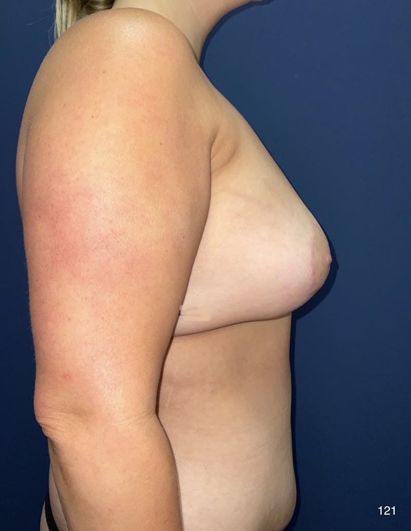 Fat Transfer to Breast by Dr. Haydon Before & After Gallery - Patient 497868 - Image 2