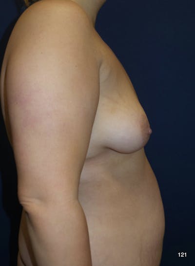 Fat Transfer to Breast by Dr. Haydon Before & After Gallery - Patient 497868 - Image 1