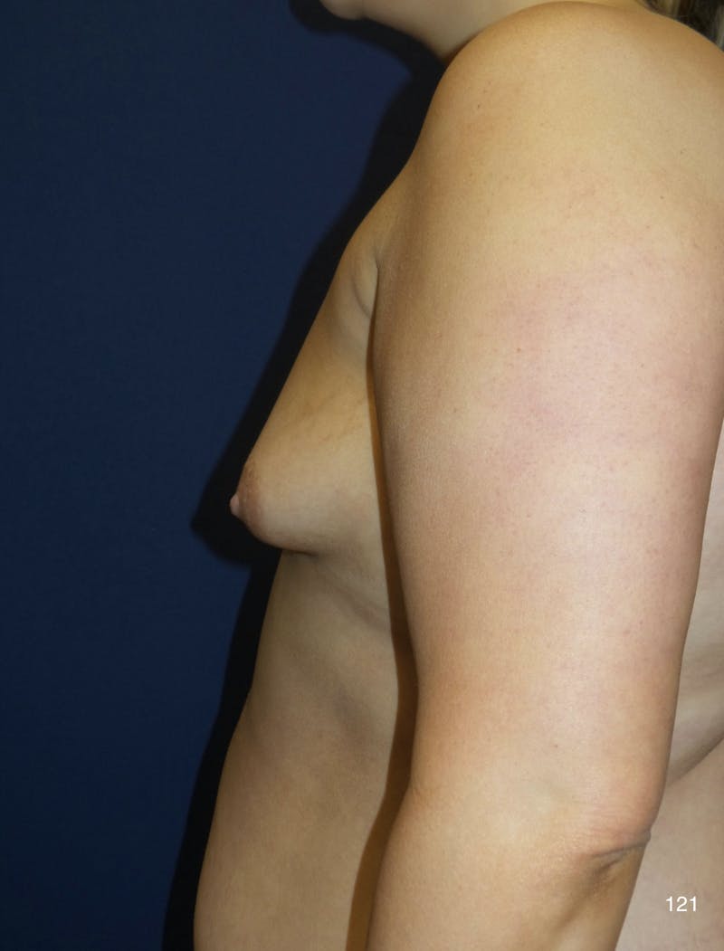 Fat Transfer to Breast by Dr. Haydon Before & After Gallery - Patient 497868 - Image 3