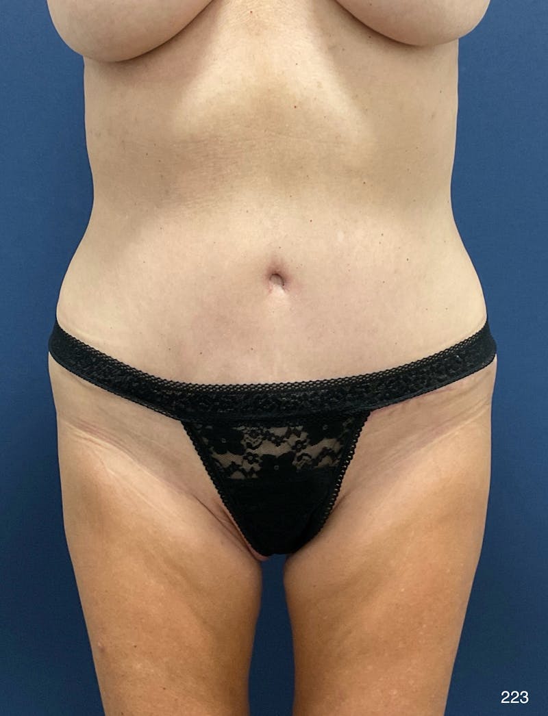 Tummy Tuck by Dr. Haydon Before & After Gallery - Patient 393990 - Image 2