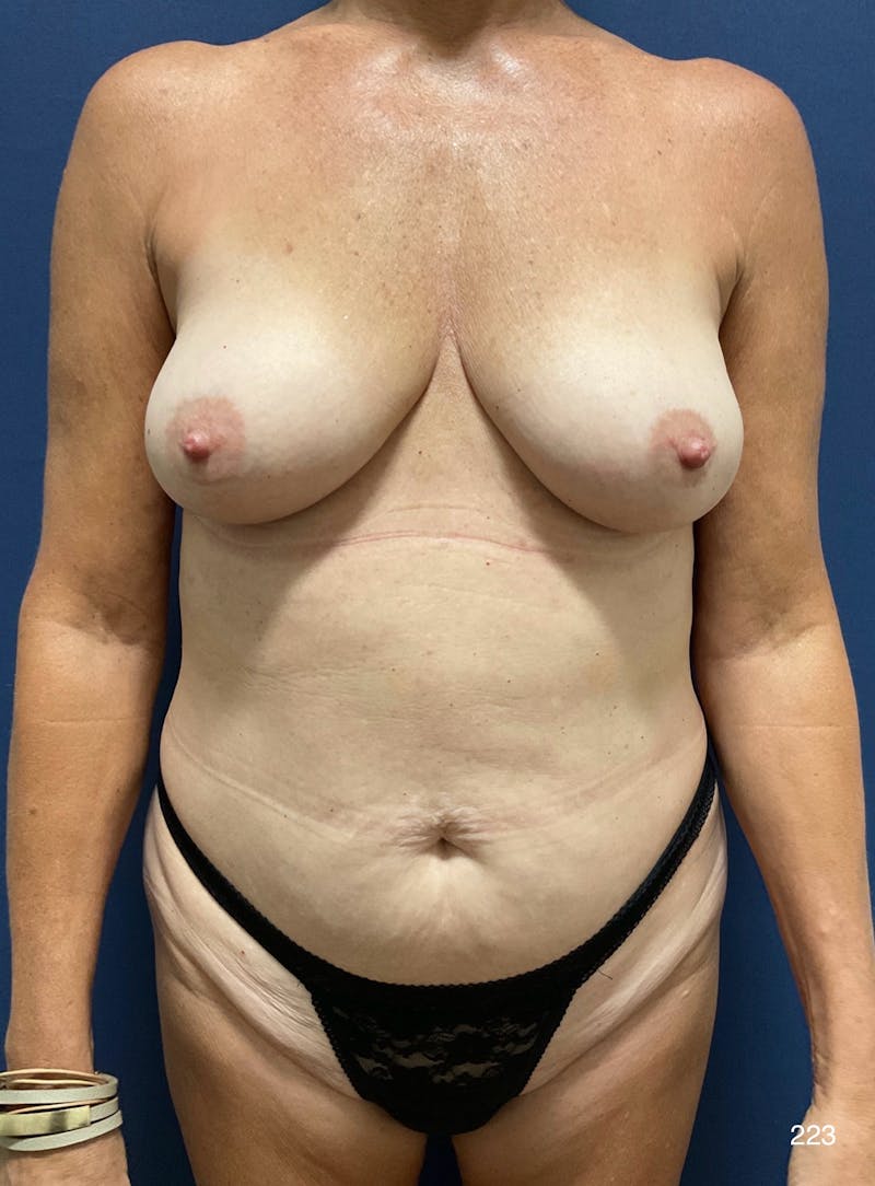 Mommy Makeover by Dr. Haydon Before & After Gallery - Patient 321468 - Image 1