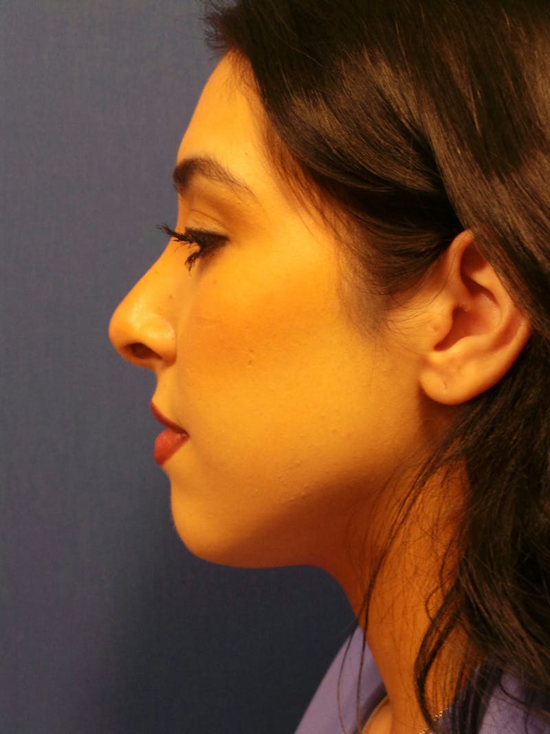 Rhinoplasty by Dr. Booth Before & After Gallery - Patient 288587 - Image 6