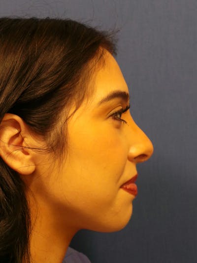 Rhinoplasty by Dr. Booth Before & After Gallery - Patient 288587 - Image 2
