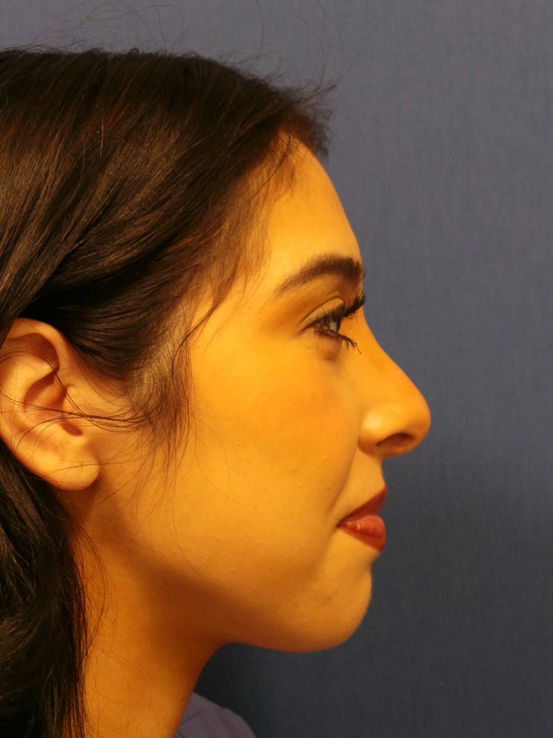 Rhinoplasty by Dr. Booth Before & After Gallery - Patient 288587 - Image 4