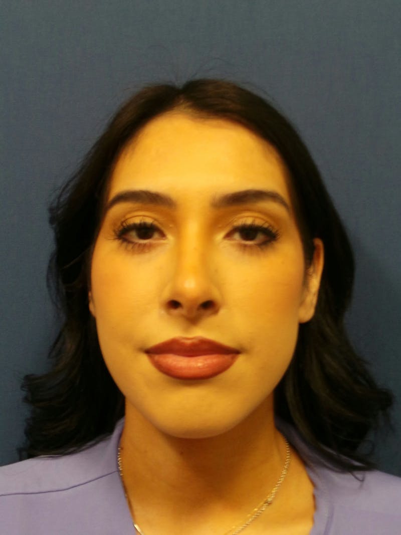 Rhinoplasty by Dr. Booth Before & After Gallery - Patient 288587 - Image 2