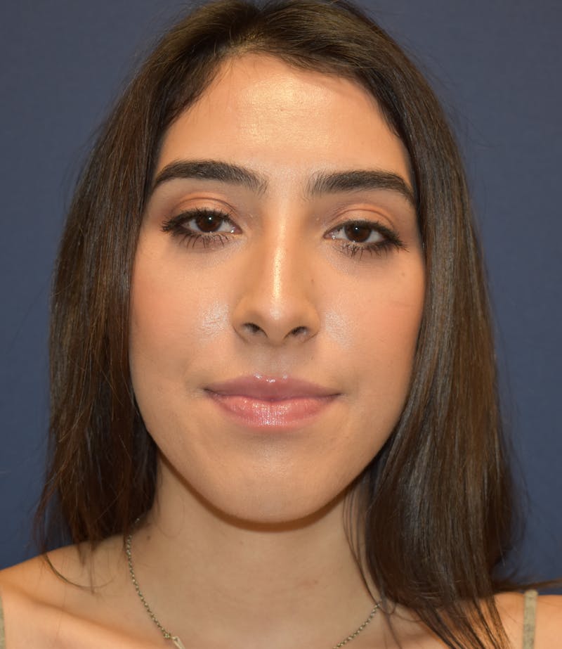 Rhinoplasty by Dr. Booth Before & After Gallery - Patient 288587 - Image 1
