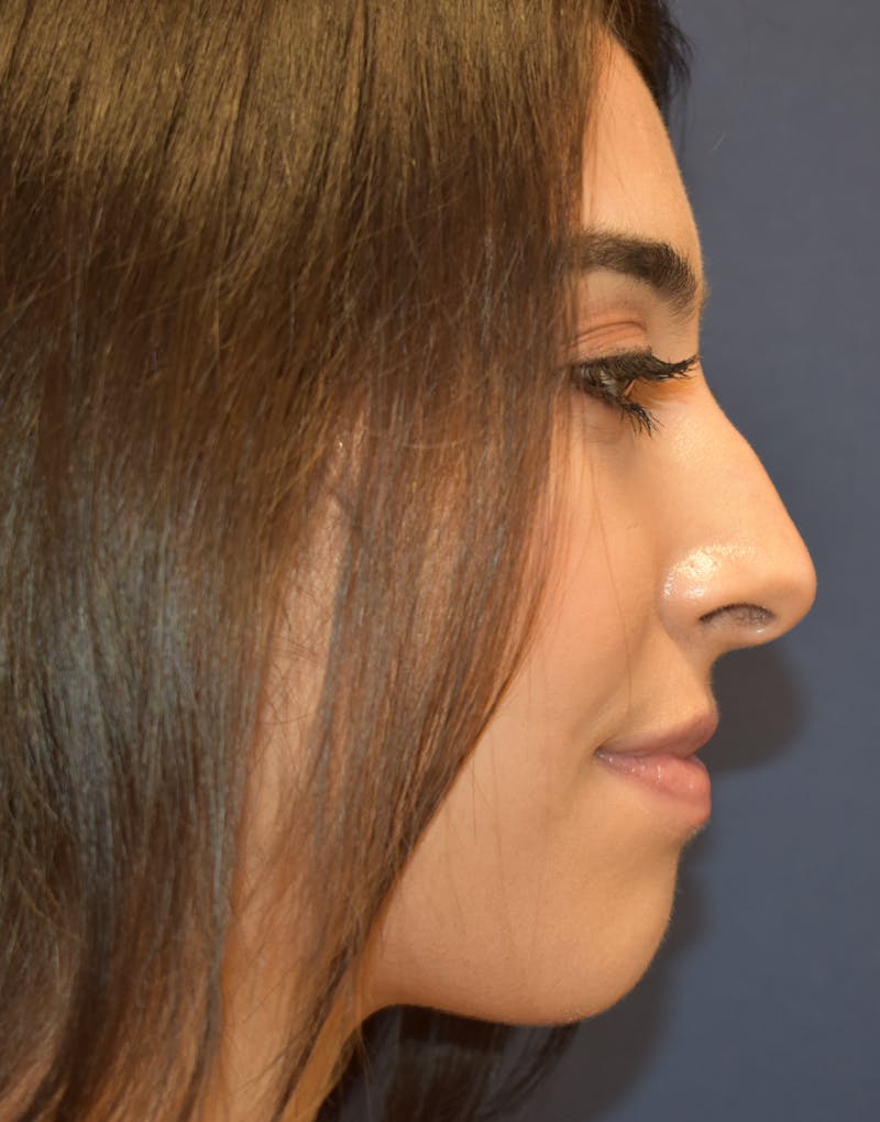 Rhinoplasty by Dr. Booth Before & After Gallery - Patient 288587 - Image 3