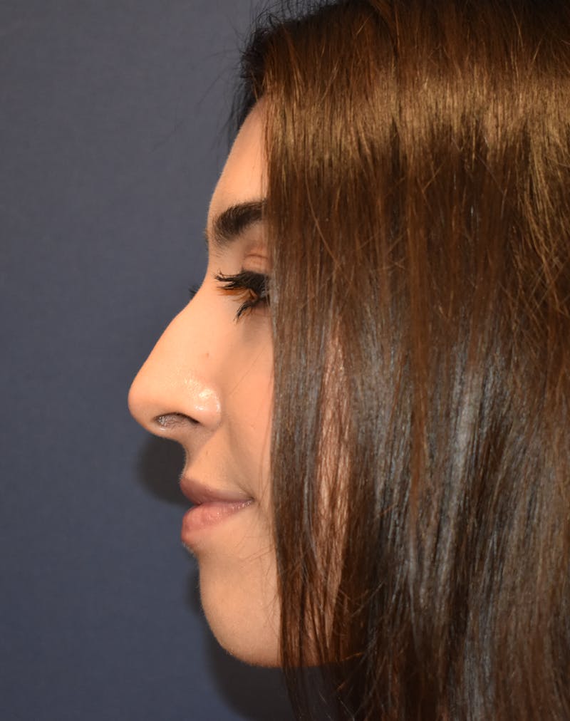 Rhinoplasty by Dr. Booth Before & After Gallery - Patient 288587 - Image 5