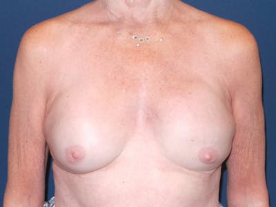 Breast Reconstruction by Dr. Booth Before & After Gallery - Patient 336860 - Image 1