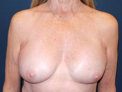 Breast Reconstruction by Dr. Booth Before & After Gallery - Patient 336860 - Image 2