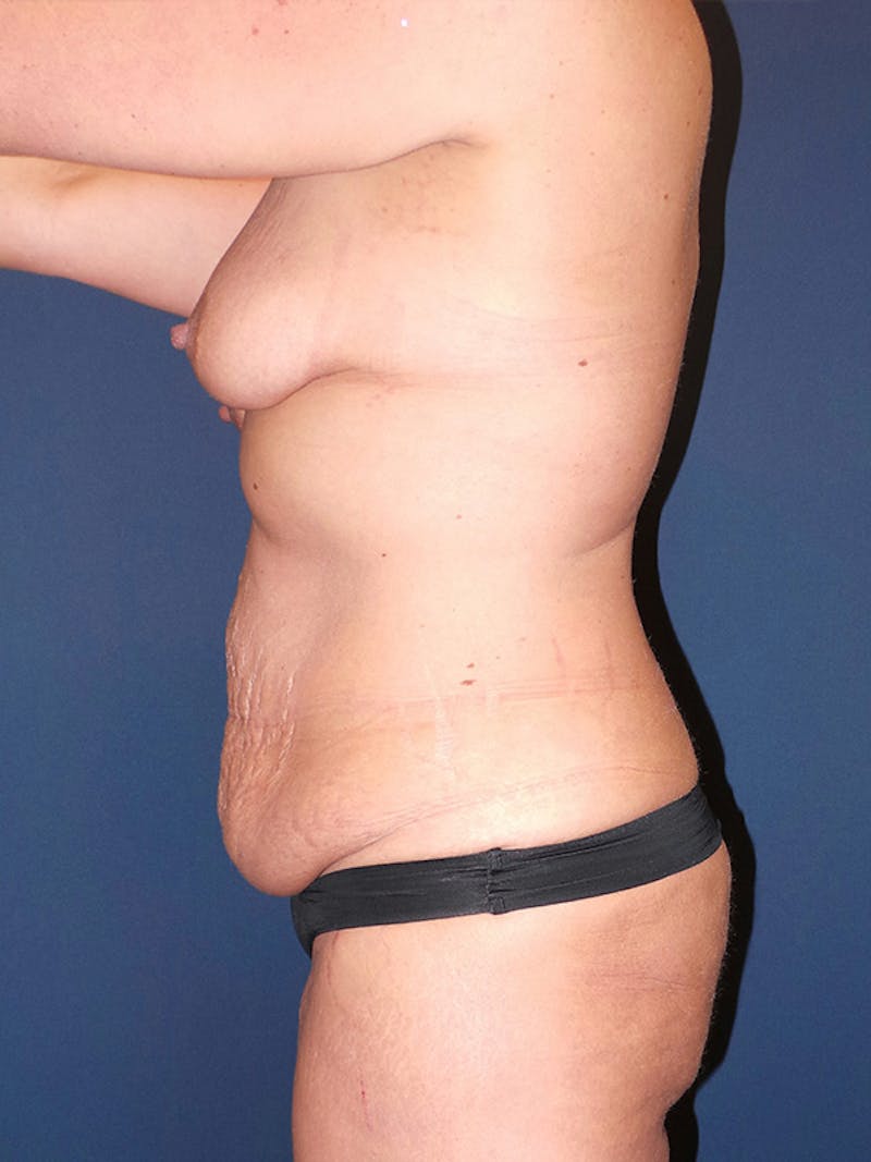 Tummy Tuck by Dr. Booth Before & After Gallery - Patient 218354 - Image 3