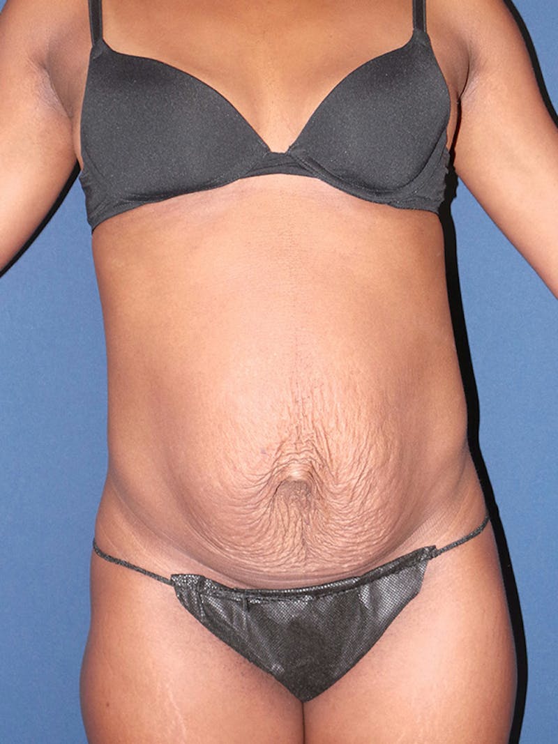 Tummy Tuck by Dr. Booth Before & After Gallery - Patient 233458 - Image 1