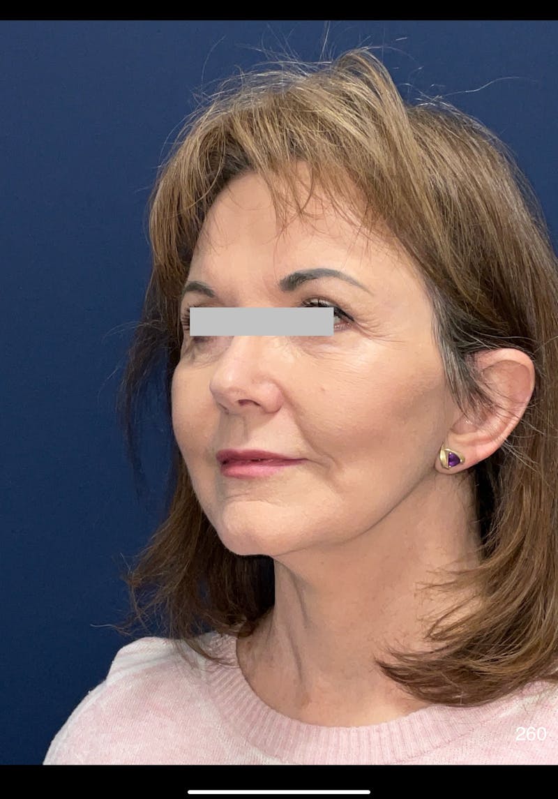 Facelift by Dr. Haydon Before & After Gallery - Patient 124673 - Image 4