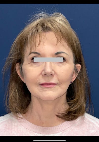 Facelift by Dr. Haydon Before & After Gallery - Patient 124673 - Image 2