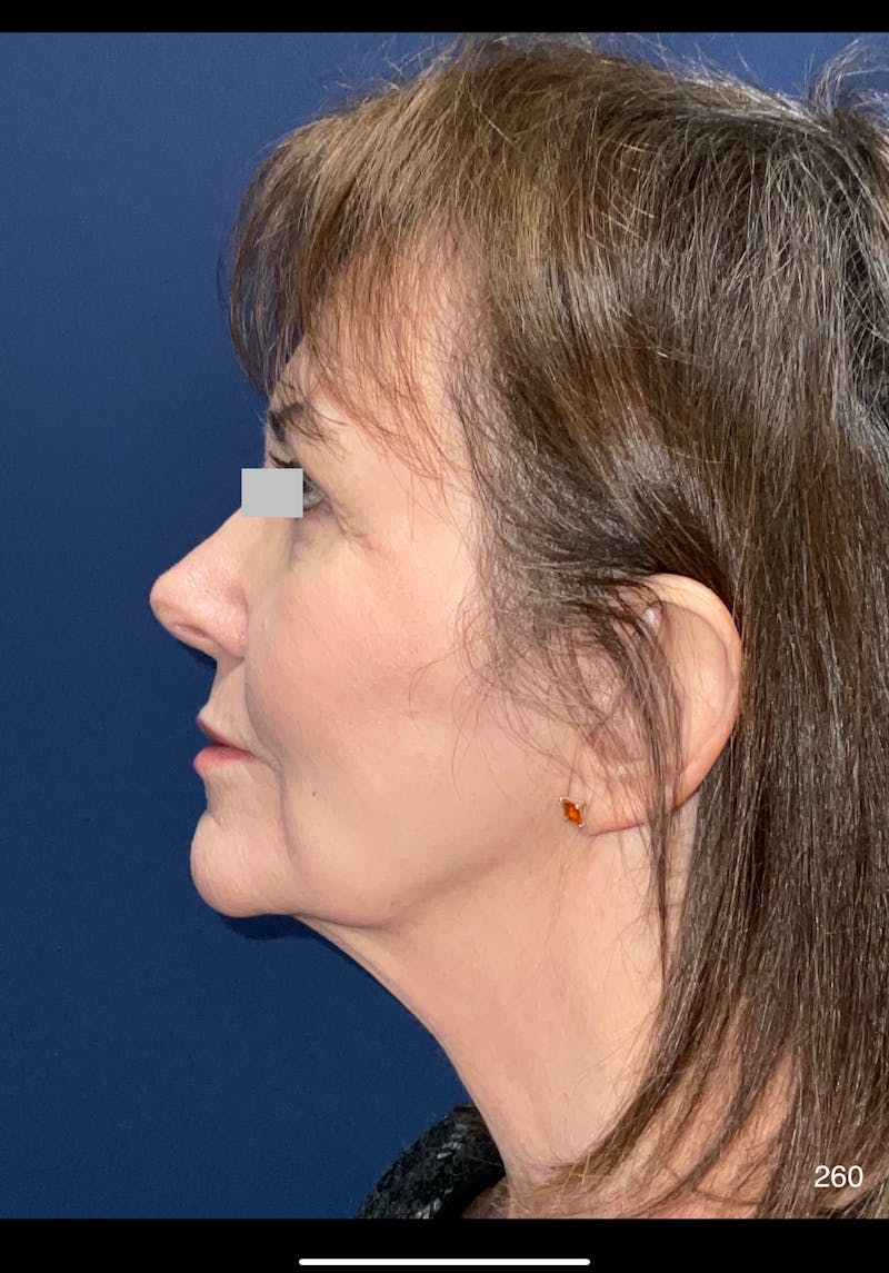 Facelift by Dr. Haydon Before & After Gallery - Patient 124673 - Image 5