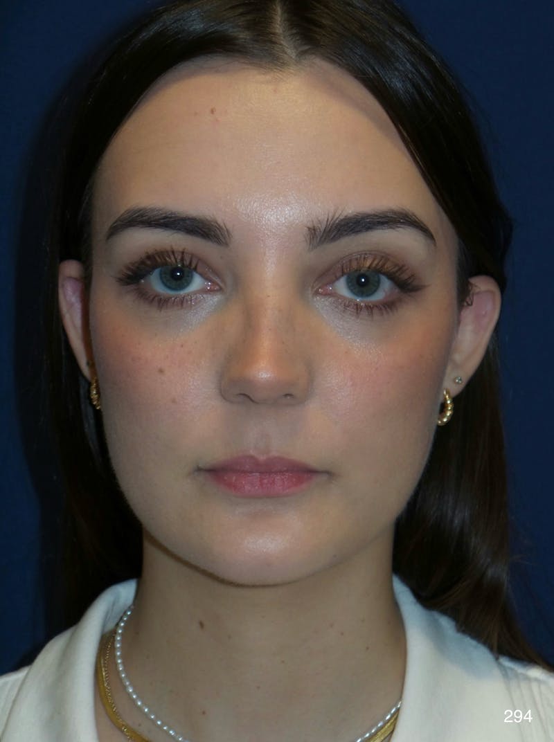 Rhinoplasty by Dr. Haydon Before & After Gallery - Patient 404723 - Image 2