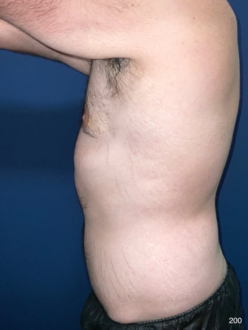 BodyTite/MorpheusBody by Dr. Haydon Before & After Gallery - Patient 325939 - Image 3