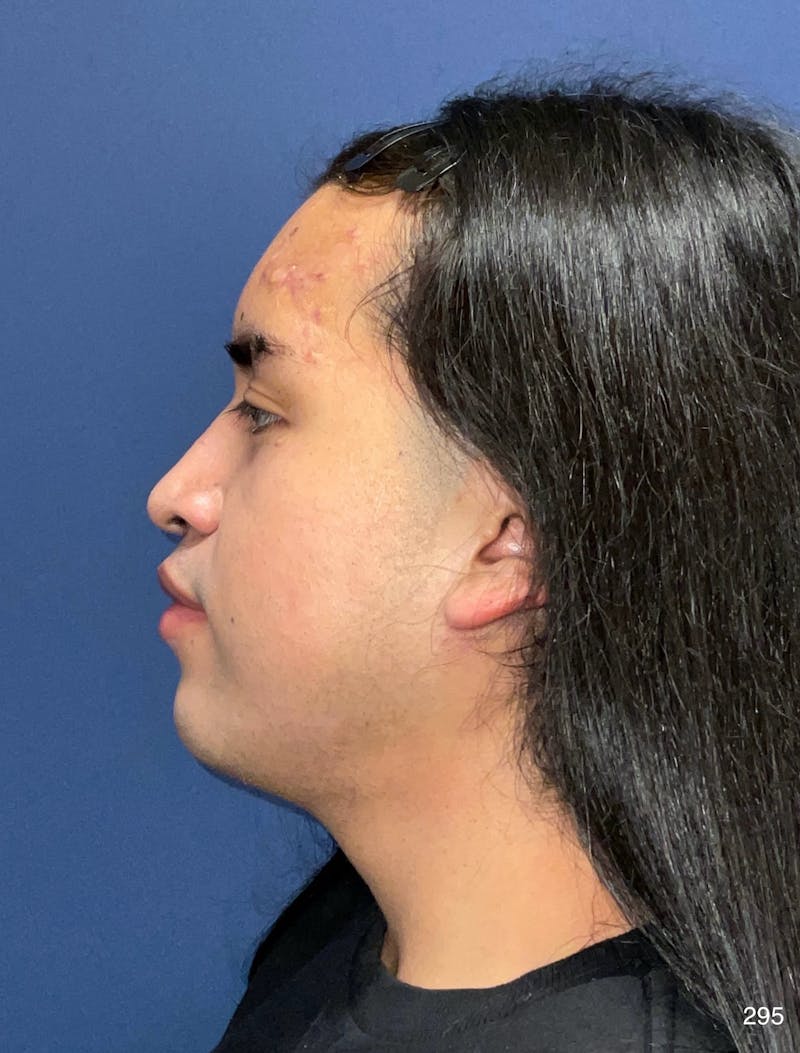 Rhinoplasty by Dr. Haydon Before & After Gallery - Patient 799675 - Image 3