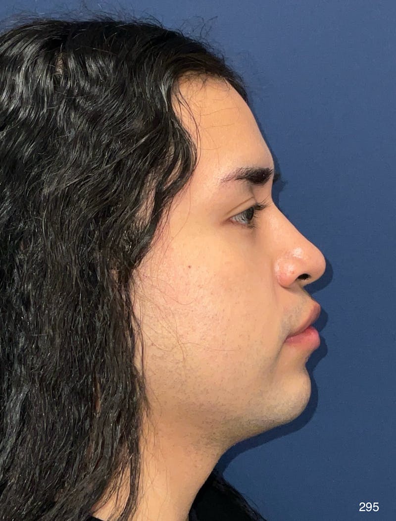 Rhinoplasty by Dr. Haydon Before & After Gallery - Patient 799675 - Image 8