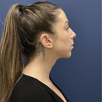 Chin Augmentation by Dr. Booth Before & After Gallery - Patient 321399 - Image 2