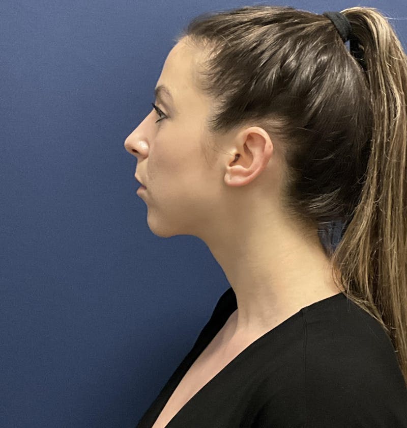 Chin Augmentation by Dr. Booth Before & After Gallery - Patient 321399 - Image 6