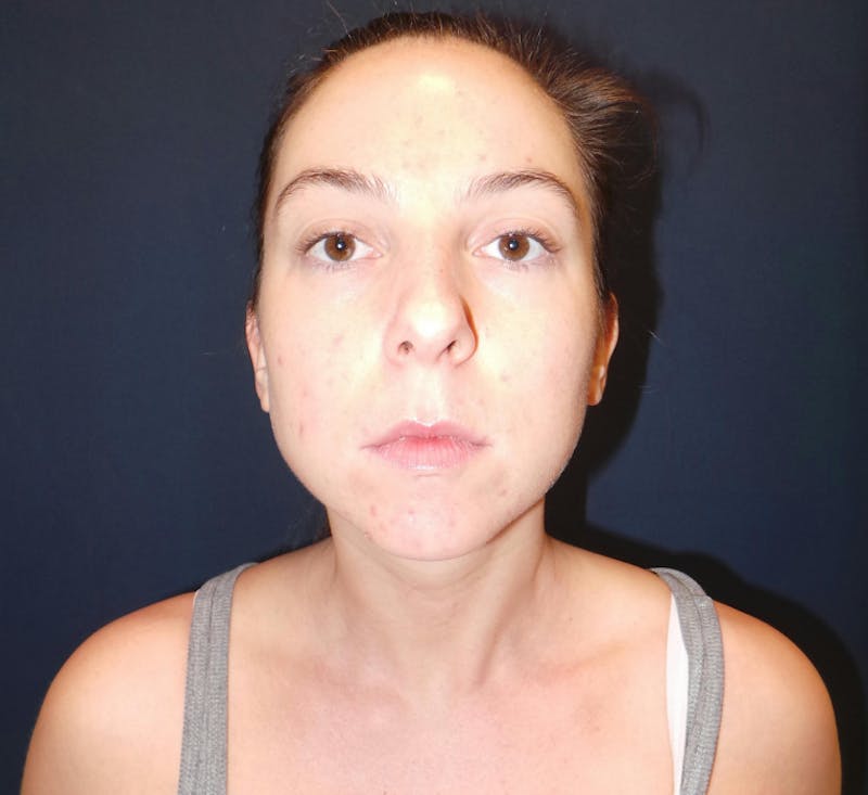 Chin Augmentation by Dr. Booth Before & After Gallery - Patient 321399 - Image 3