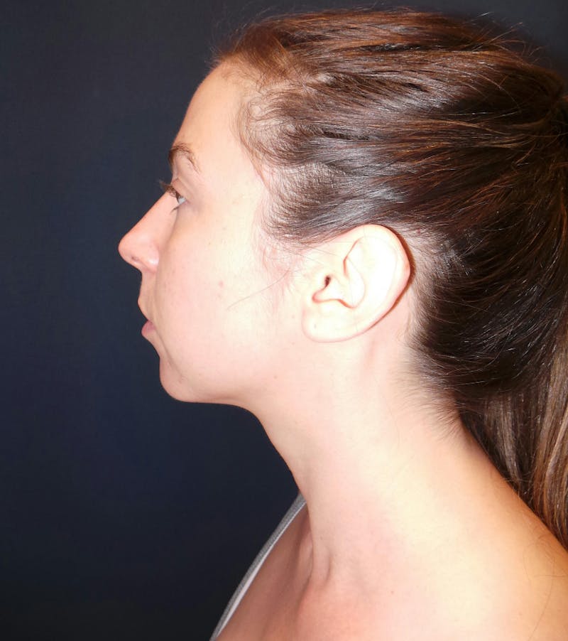 Chin Augmentation by Dr. Booth Before & After Gallery - Patient 321399 - Image 5