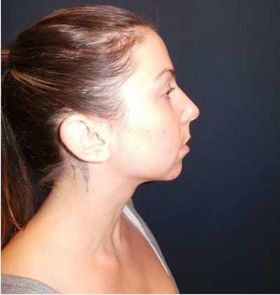 Chin Augmentation by Dr. Booth Before & After Gallery - Patient 321399 - Image 1