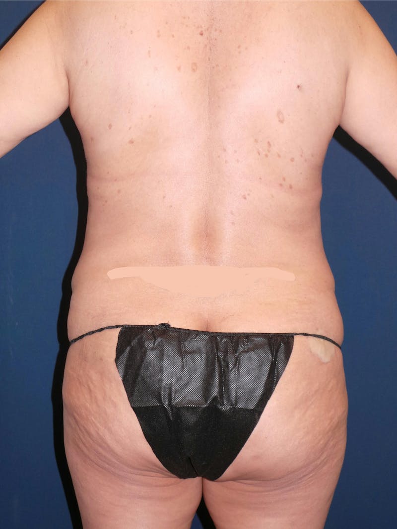BodyTite by Dr. Booth Before & After Gallery - Patient 218018 - Image 7