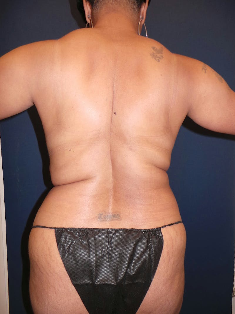 Liposuction by Dr. Booth Before & After Gallery - Patient 108250 - Image 11