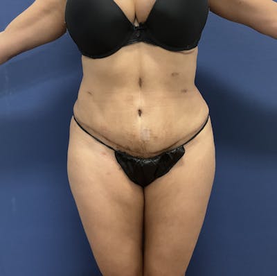 Liposuction by Dr. Booth Before & After Gallery - Patient 108250 - Image 2