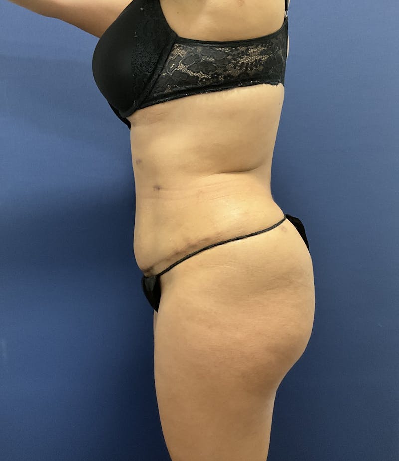 Liposuction by Dr. Booth Before & After Gallery - Patient 108250 - Image 10