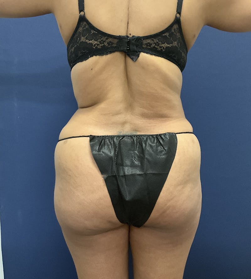 Liposuction by Dr. Booth Before & After Gallery - Patient 108250 - Image 12