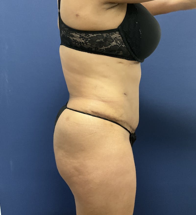 Liposuction by Dr. Booth Before & After Gallery - Patient 108250 - Image 6