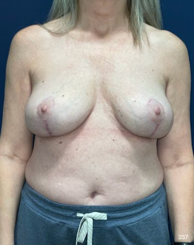 Implant Removal by Dr. Haydon Before & After Gallery - Patient 897910 - Image 2