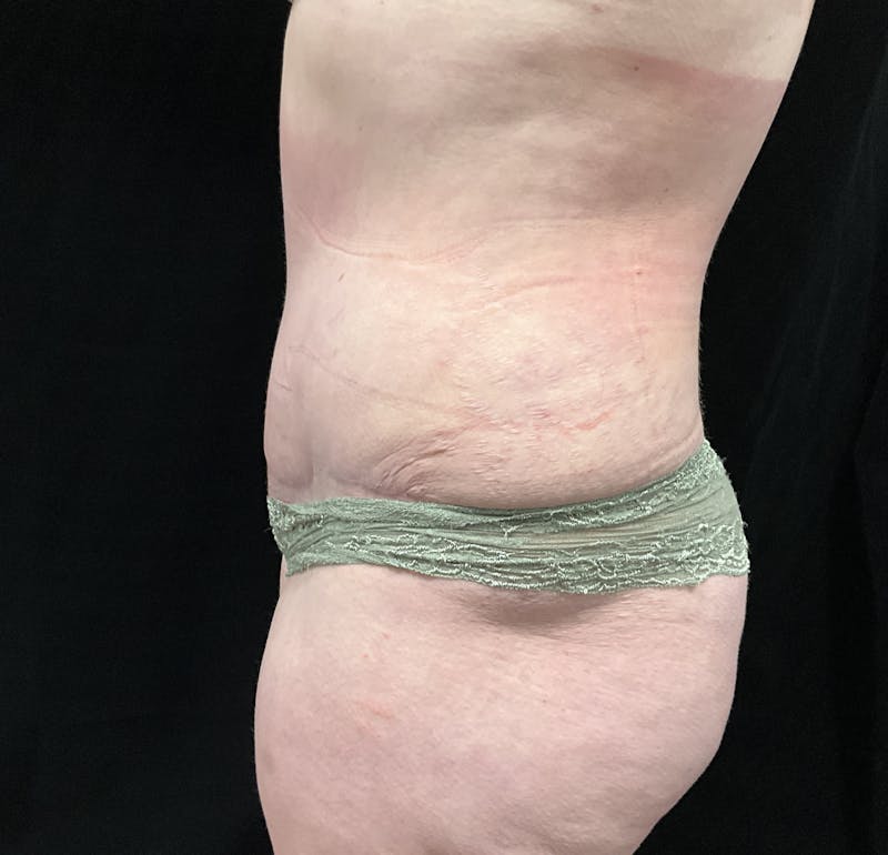Liposuction by Dr. Booth Before & After Gallery - Patient 163466 - Image 4