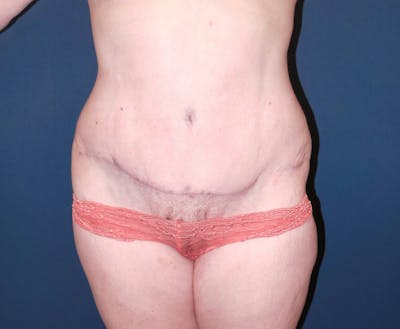 Tummy Tuck by Dr. Booth Before & After Gallery - Patient 343290 - Image 2