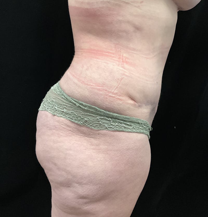 Tummy Tuck by Dr. Booth Before & After Gallery - Patient 343290 - Image 6