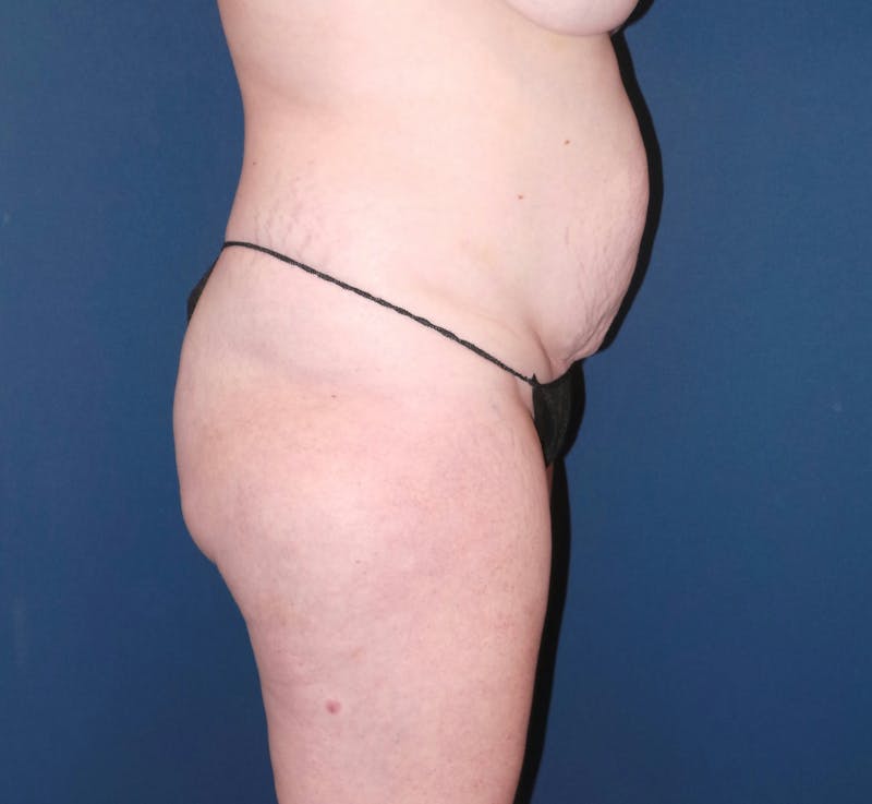 Liposuction by Dr. Booth Before & After Gallery - Patient 163466 - Image 5