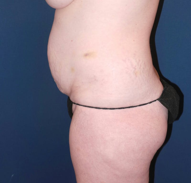 Tummy Tuck by Dr. Booth Before & After Gallery - Patient 343290 - Image 3
