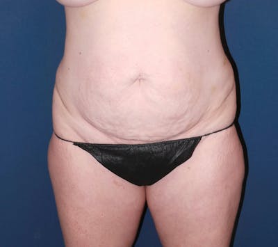 Tummy Tuck by Dr. Booth Before & After Gallery - Patient 343290 - Image 1