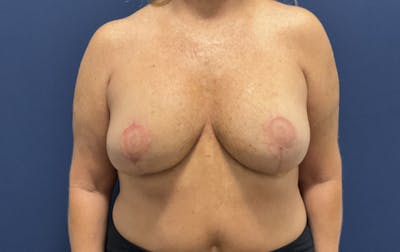  Breast Lift with Implant Exchange Dr. Booth Before & After Gallery - Patient 387091 - Image 2
